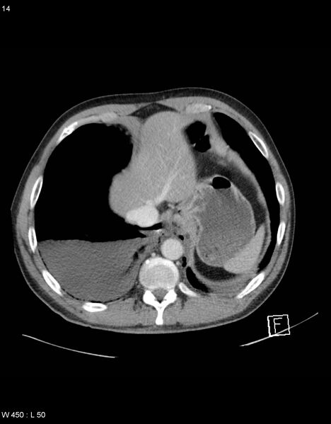 File:Boerhaave syndrome with tension pneumothorax (Radiopaedia 56794-63603 A 7).jpg