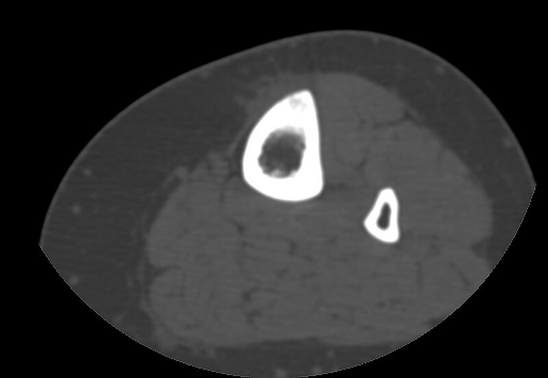 File:Bone metastasis - tibia (Radiopaedia 57665-64609 Axial bone window 127).jpg