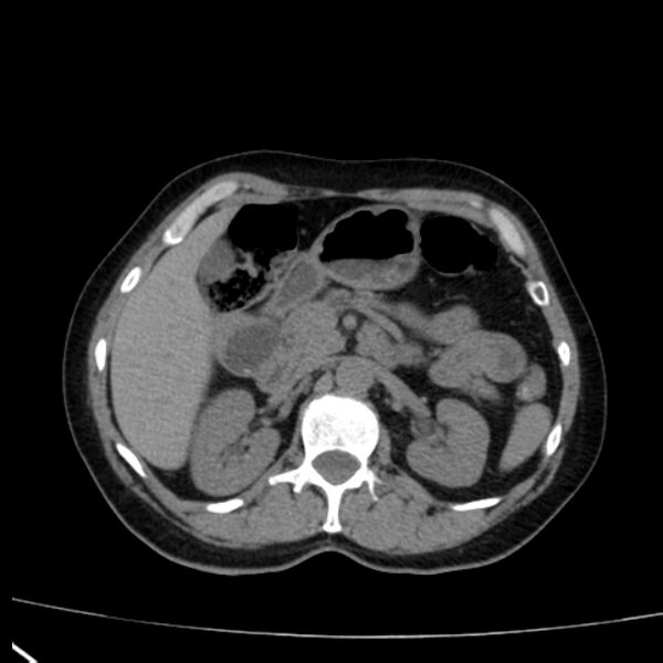 File:Bosniak renal cyst - type I (Radiopaedia 27479-27675 Axial non-contrast 30).jpg