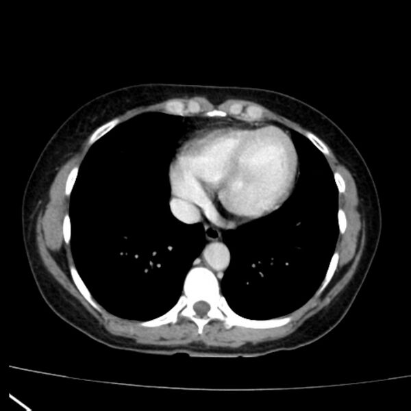 File:Bosniak renal cyst - type I (Radiopaedia 27479-27675 C 1).jpg