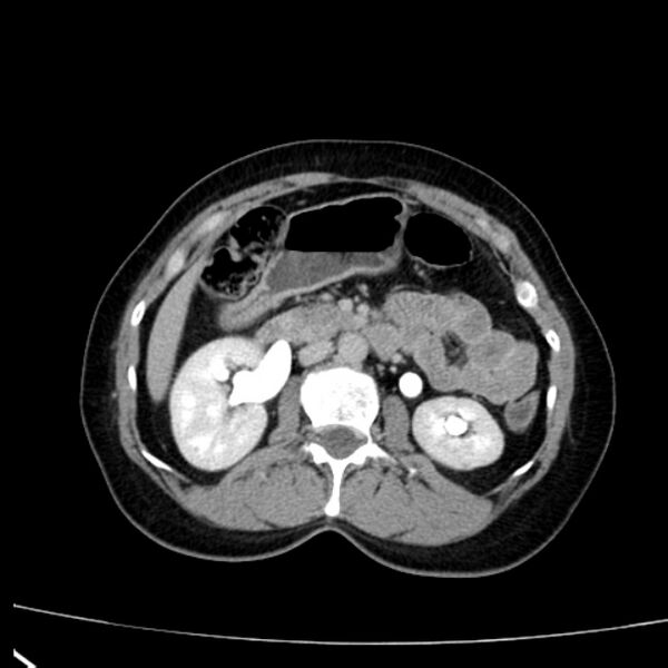 File:Bosniak renal cyst - type I (Radiopaedia 27479-27675 D 19).jpg