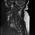 Brachial plexopathy (Radiopaedia 21844-21806 Sagittal T2 2).jpg
