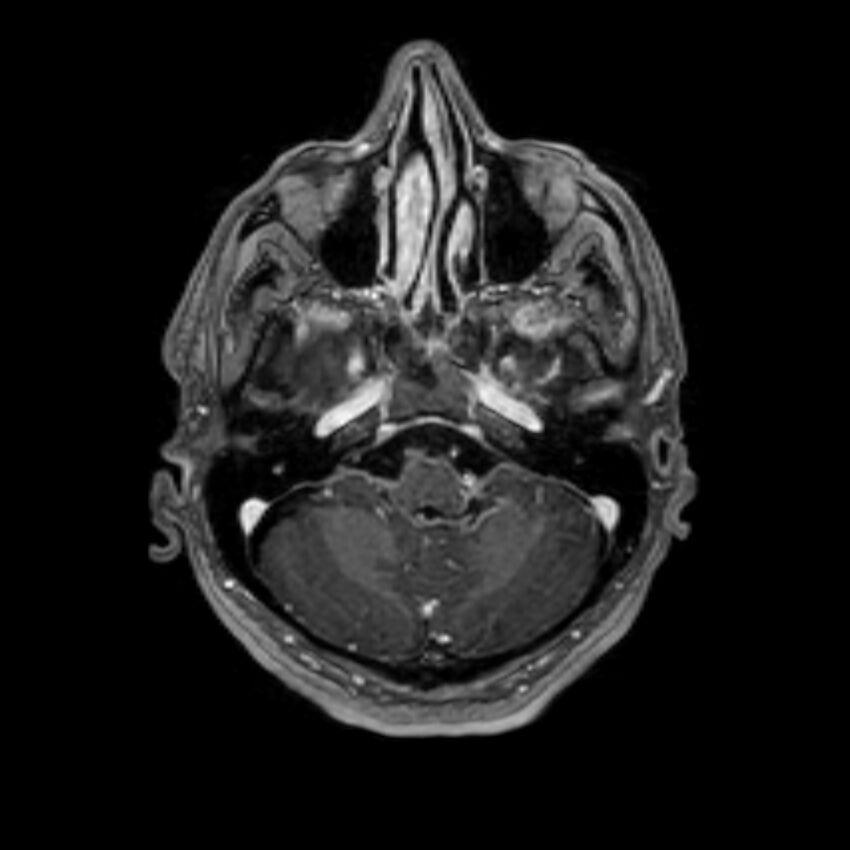 Brain abscess complicated by intraventricular rupture and ventriculitis (Radiopaedia 82434-96577 Axial T1 C+ 10).jpg