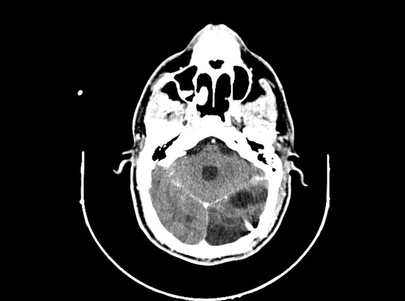 File:Brain injury by firearm projectile (Radiopaedia 82068-96088 B 90).jpg