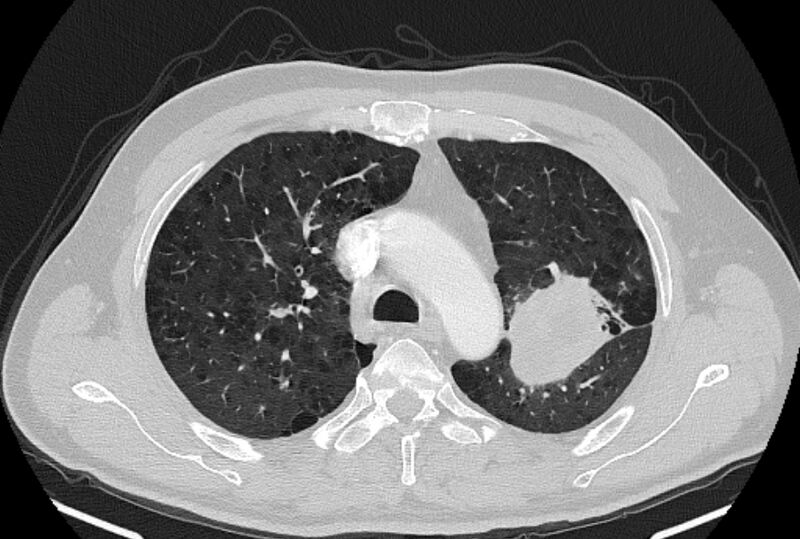 File:Brain metastases - lung cancer primary (Radiopaedia 75060-86116 Axial lung window 16).jpg