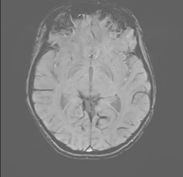 File:Brainstem glioma (Radiopaedia 70548-80674 Axial SWI 29).jpg