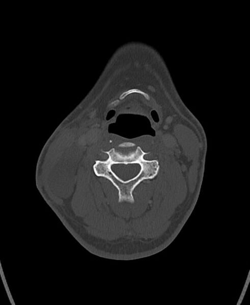 File:Branchial cleft cyst (Radiopaedia 31167-31875 Axial bone window 38).jpg