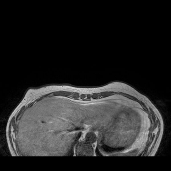 File:Breast implants - MRI (Radiopaedia 26864-27035 Axial T1 2).jpg