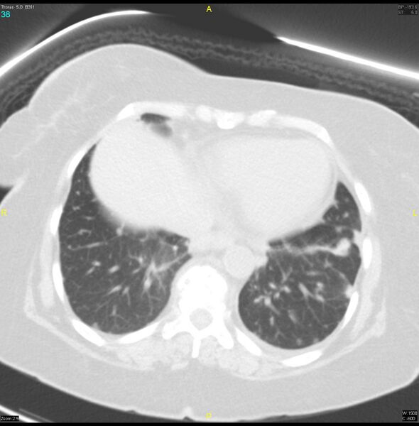 File:Breast primary with lung and bone metastases (Radiopaedia 40620-43228 Axial lung window 38).jpg