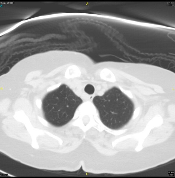 File:Breast primary with lung and bone metastases (Radiopaedia 40620-43228 Axial lung window 8).jpg