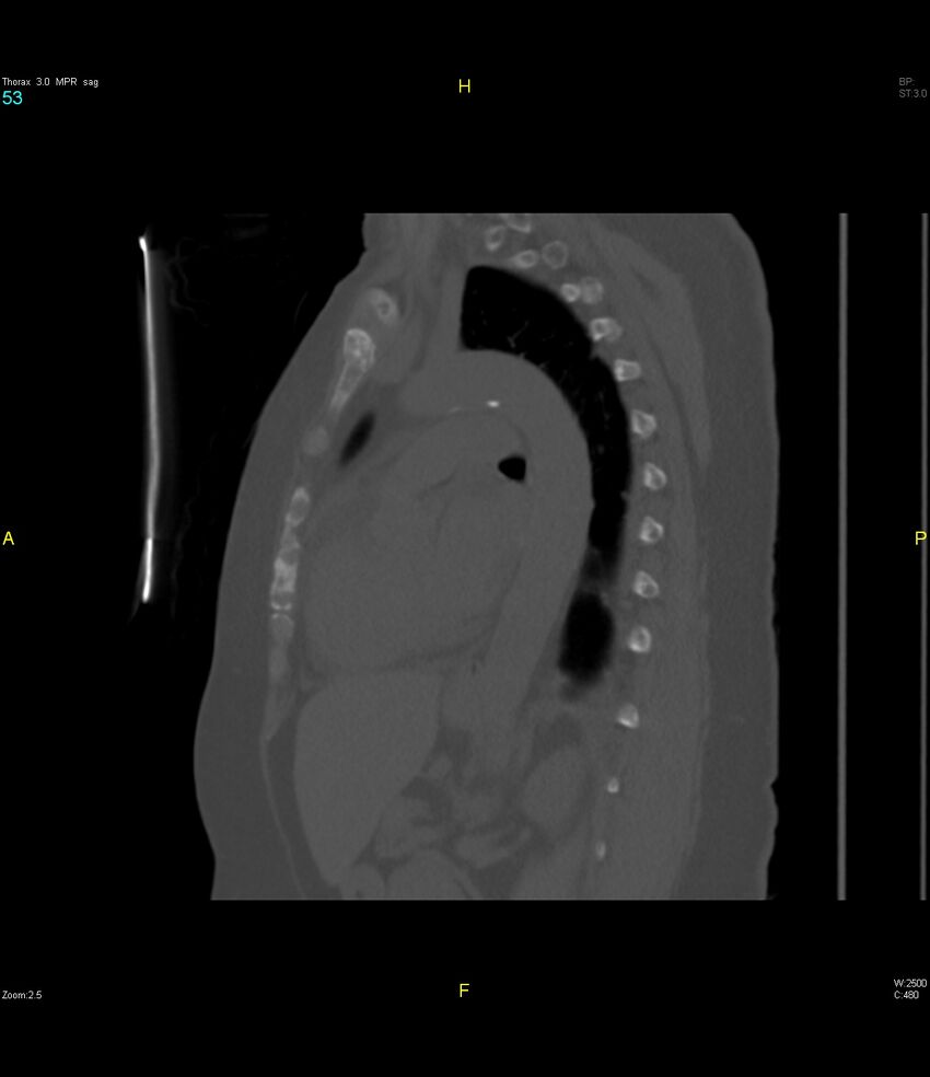 Breast primary with lung and bone metastases (Radiopaedia 40620-43228 Sagittal bone window 53).jpg