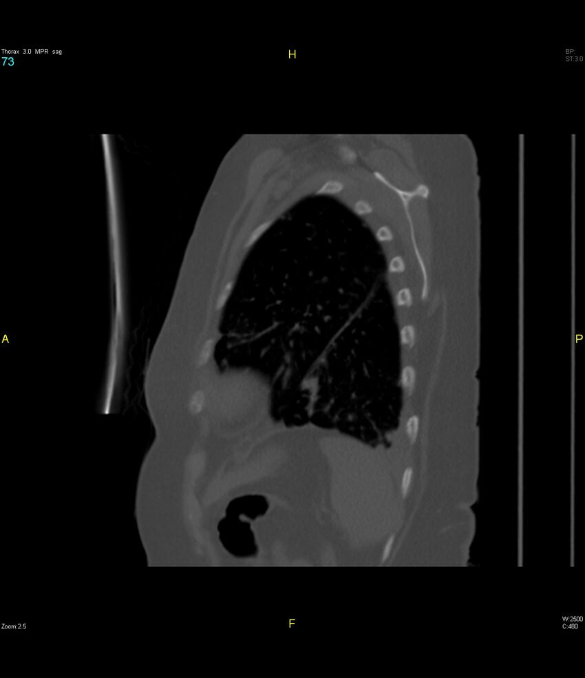 Breast primary with lung and bone metastases (Radiopaedia 40620-43228 Sagittal bone window 73).jpg
