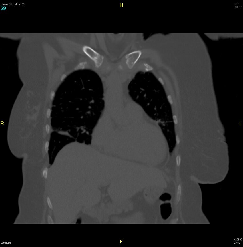 Breast primary with lung and bone metastases (Radiopaedia 40620-43228 bone window 29).jpg