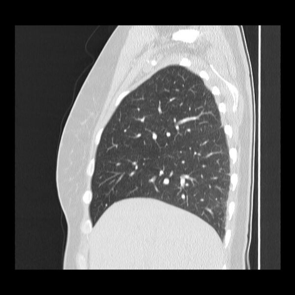 File:Bronchial atresia (Radiopaedia 22965-22992 Sagittal lung window 42).jpg