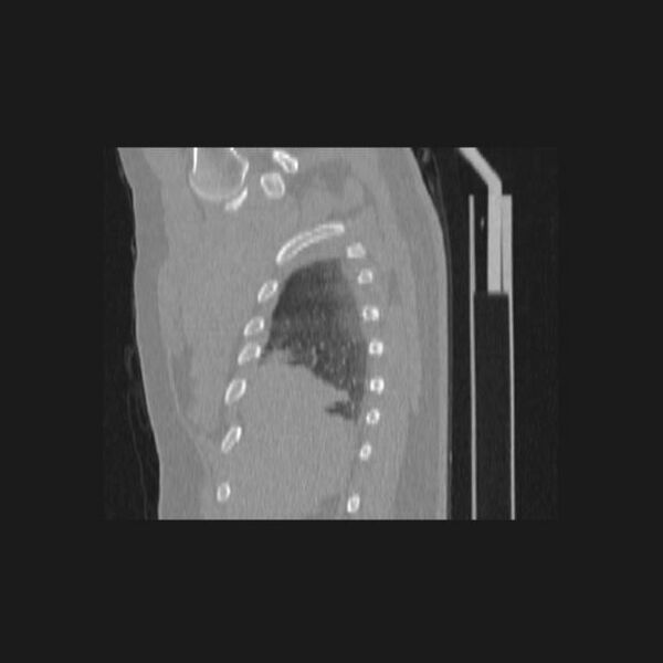 File:Bronchial atresia (Radiopaedia 60685-68439 Sagittal lung window 7).jpg