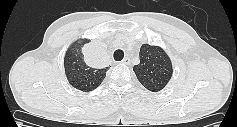 File:Bronchogenic carcinoma with superior vena cava syndrome (Radiopaedia 36497-38054 Axial lung window 18).jpg