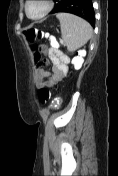 File:Brown tumors compressing the spinal cord (Radiopaedia 68442-77988 F 45).jpg
