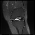 Bucket handle tear - lateral meniscus (Radiopaedia 7246-8187 Coronal T2 fat sat 15).jpg