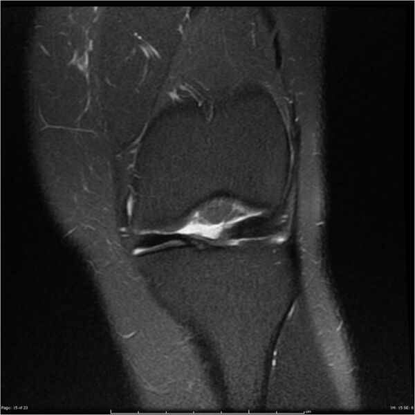 File:Bucket handle tear - lateral meniscus (Radiopaedia 7246-8187 Coronal T2 fat sat 15).jpg