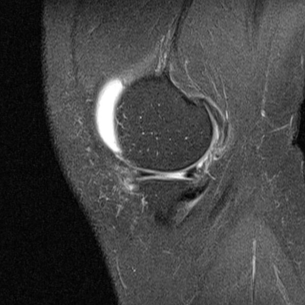 File:Bucket handle tear - medial meniscus (Radiopaedia 79028-91942 Sagittal PD fat sat 21).jpg