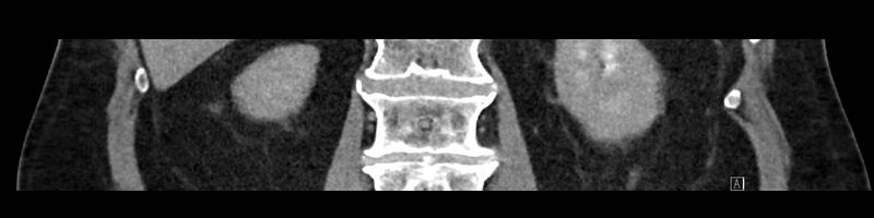 File:Buried bumper syndrome - gastrostomy tube (Radiopaedia 63843-72575 Coronal Inject 71).jpg