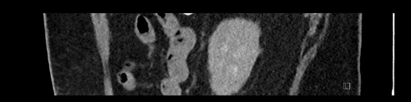 File:Buried bumper syndrome - gastrostomy tube (Radiopaedia 63843-72575 Sagittal Inject 26).jpg