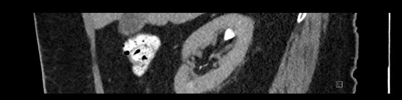 File:Buried bumper syndrome - gastrostomy tube (Radiopaedia 63843-72575 Sagittal Inject 87).jpg