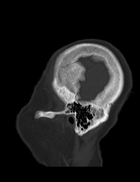 File:Burnt-out meningioma (Radiopaedia 51557-57337 Sagittal bone window 3).jpg