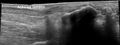 Calcaneal tuberosity avulsion fracture - ultrasound (Radiopaedia 29978-30524 B 1).jpg