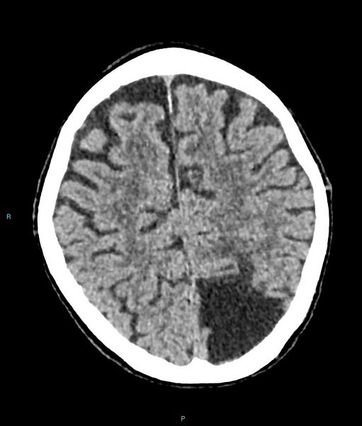 File:Calcified cerebral emboli from left ventricular thrombus (Radiopaedia 84420-99758 Axial non-contrast 29).jpg