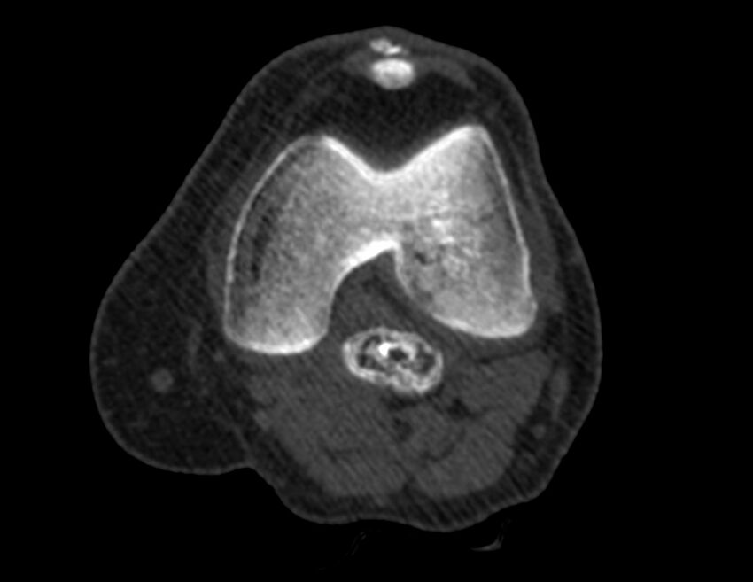 Calcified hematoma - popliteal fossa (Radiopaedia 63938-72763 Axial bone window 10).jpg