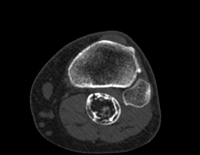 File:Calcified hematoma - popliteal fossa (Radiopaedia 63938-72763 Axial bone window 67).jpg