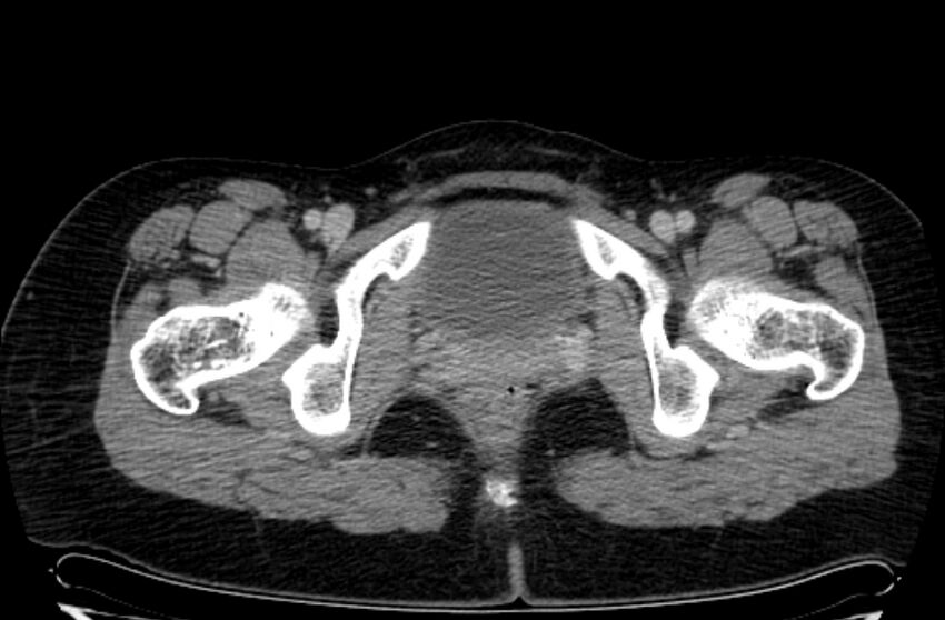 Cannonball metastases - uterine choriocarcinoma (Radiopaedia 70137-80174 A 57).jpg