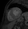 Cardiac amyloidosis - ATTR wild-type (Radiopaedia 74412-85353 Look-Locker 6).jpg
