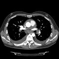 Cardiac tamponade (Radiopaedia 78607-91368 Axial C+ CTPA 40).jpg