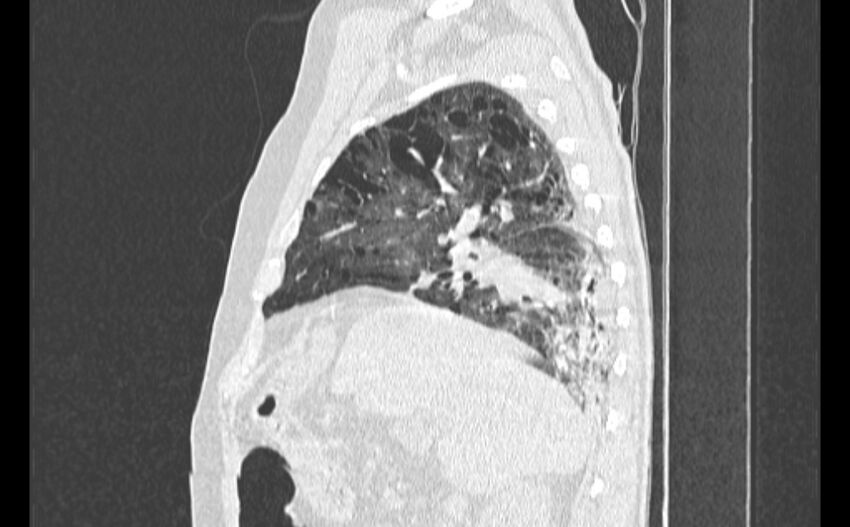 Cavitating bronchogenic carcinoma (Radiopaedia 44489-48162 Sagittal lung window 15).jpg