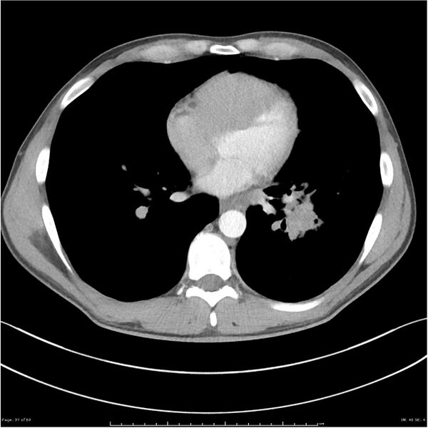 File:Cavitating lung cancer (Radiopaedia 25796-25945 C+ arterial phase 37).jpg