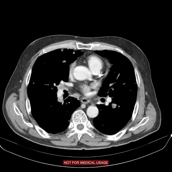 File:Cavitating pulmonary metastases (Radiopaedia 24920-25184 B 14).jpg