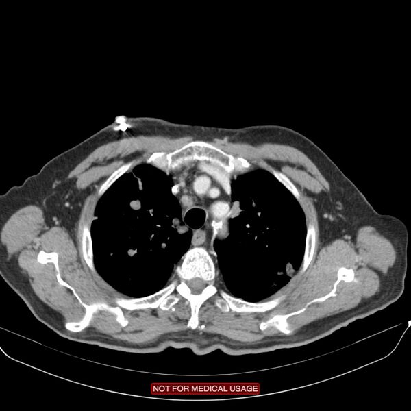 File:Cavitating pulmonary metastases (Radiopaedia 24920-25184 B 4).jpg