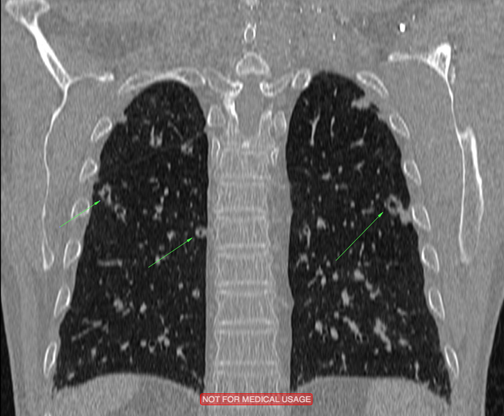 File:Cavitating pulmonary metastases (Radiopaedia 24920-25187 Coronal MPR 1).png