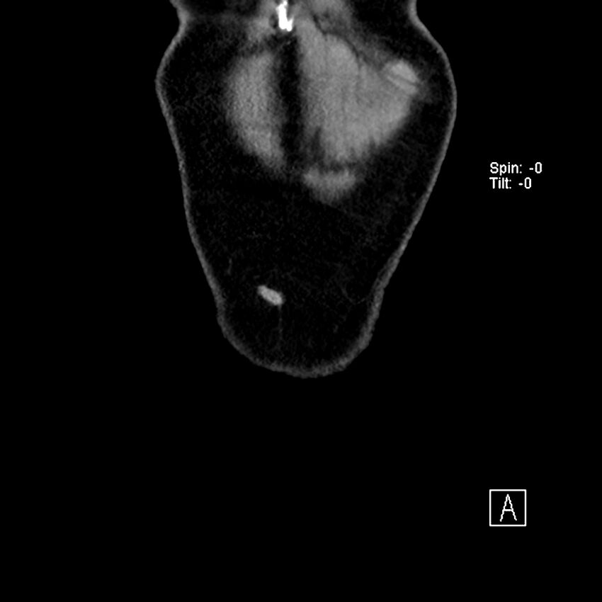 Cecal volvulus (Radiopaedia 90897-108397 Coronal non-contrast 58).jpg