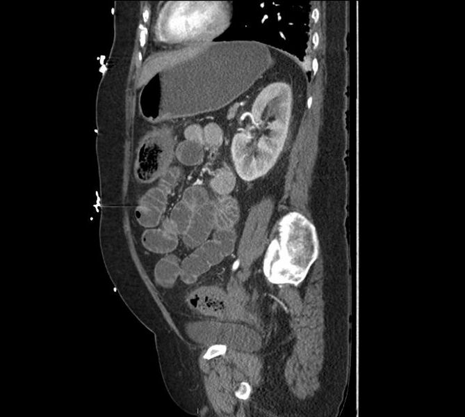 File:Celiac artery severe stenosis and dissection (Radiopaedia 44128-47842 A 12).jpg