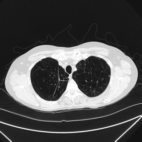 File:Centrilobular pulmonary emphysema (Radiopaedia 24495-24789 Axial lung window 16).jpg