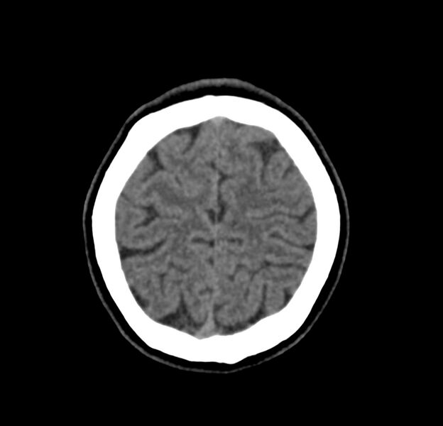 File:Cerebellar agenesis (Radiopaedia 30203-30817 Axial non-contrast 43).jpg