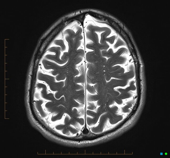 File:Cerebellar gangliocytoma (Radiopaedia 65377-74422 Axial T2 30).jpg