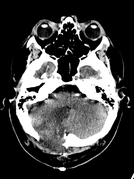 File:Cerebellar infarct due to vertebral artery dissection with posterior fossa decompression (Radiopaedia 82779-97032 Axial non-contrast 6).png