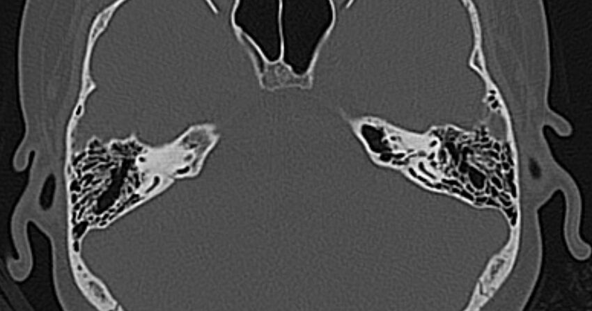 Cerebellopontine angle lipoma (Radiopaedia 57303-64242 Axial bone window 38).jpg