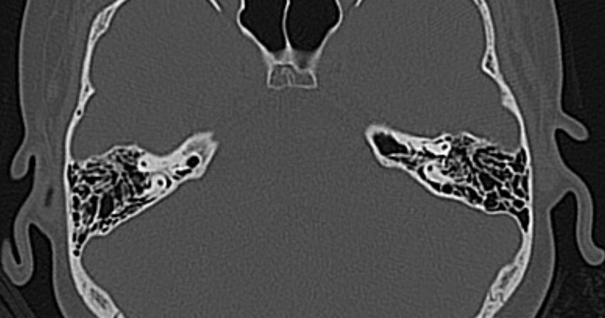 Cerebellopontine angle lipoma (Radiopaedia 57303-64242 Axial bone window 40).jpg