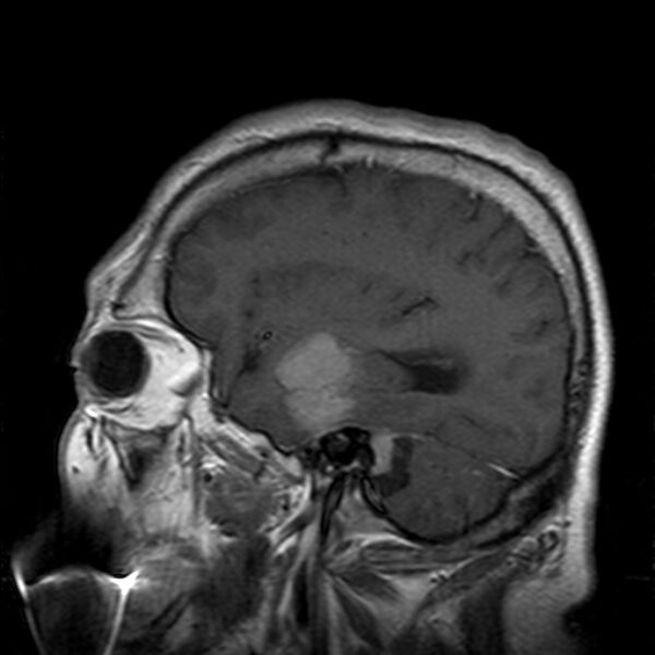 File:Cerebellopontine angle meningioma (Radiopaedia 24459-24764 Sagittal T1 C+ 6).jpg