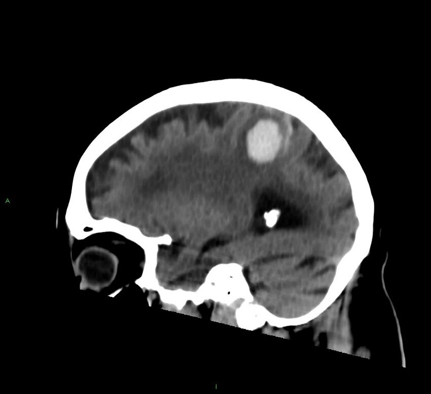 Cerebral amyloid angiopathy-associated lobar intracerebral hemorrhage (Radiopaedia 58376-65513 C 28).jpg